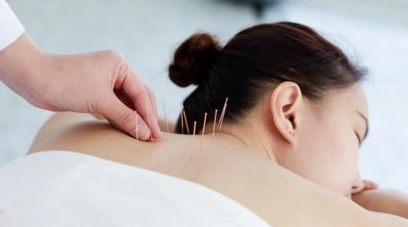 Agopuntura benefici e controindicazioni - Immagine di donna sottoposta all'agopuntura